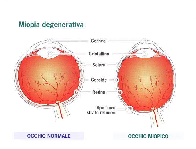 Miopie și degenerescență maculară,