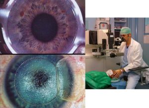 lasik, medie miopie, elevate ipermetropie ed astigmatismi ipermetropici, Dott. Elias Michael